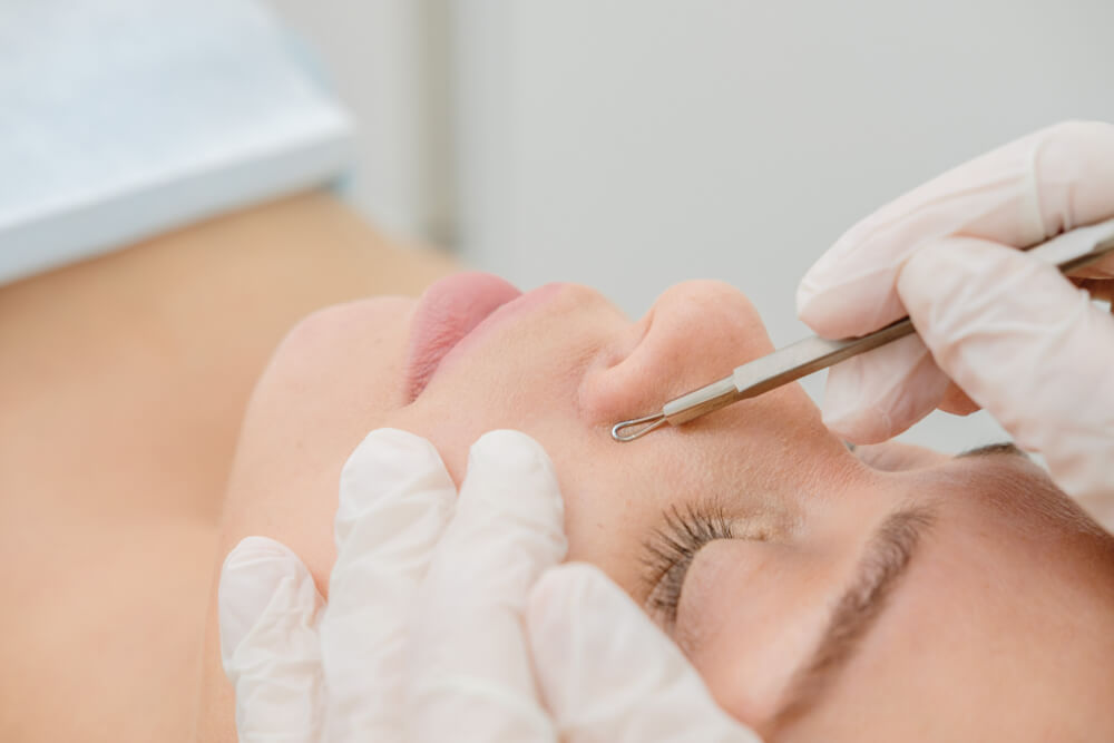 Procedure,For,Cleaning,Skin,With,Steel,Tool,From,Blackheads,And