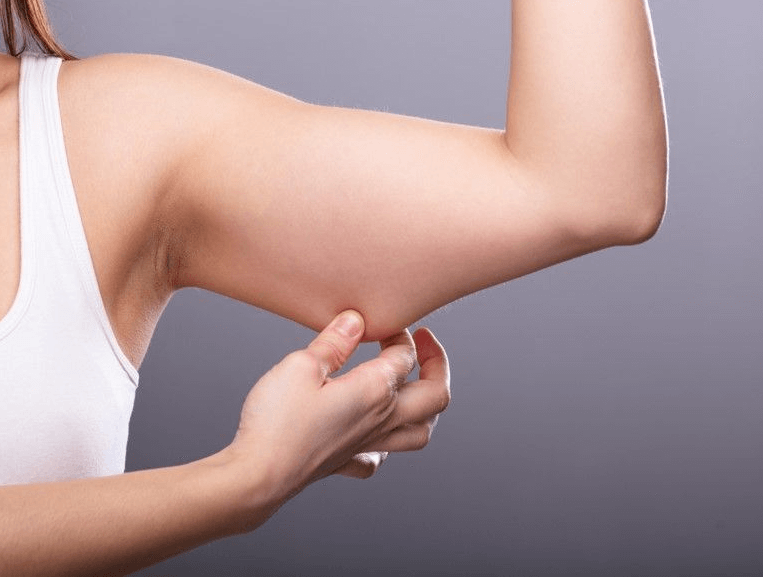 flabby-arms
